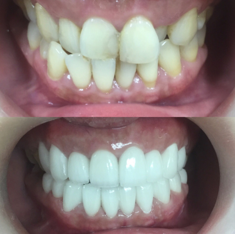 Nha Khoa Răng Sứ - Porcelain Dentistry