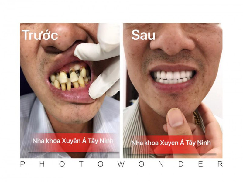 Nha Khoa Xuyên Á