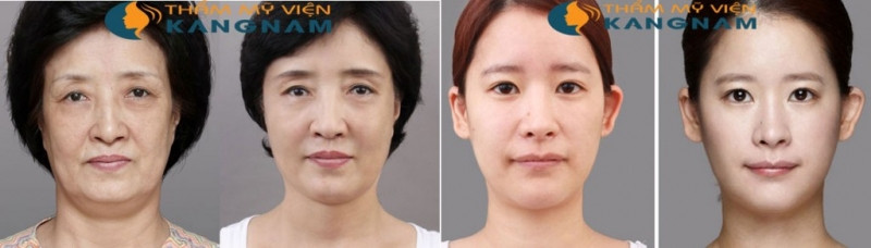 Kết quả khác biệt hoàn toàn khi căng da mặt tại Kangnam