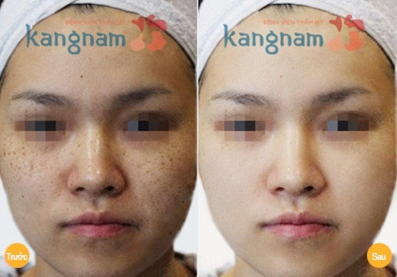 Trước và sau điều trị nám của khách hàng tại Kangnam