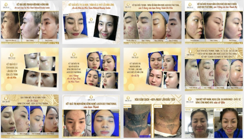 Miss Trâm - Natural Beauty Center: Nơi chuyên điều trị nám, tàn nhang uy tín có cam kết ở HCM