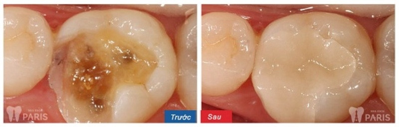 Kết quả trám răng của khách hàng tại Nha khoa Paris