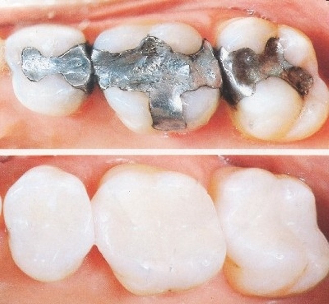 Kết quả hàn trám răng tại Nha khoa Lạc Việt