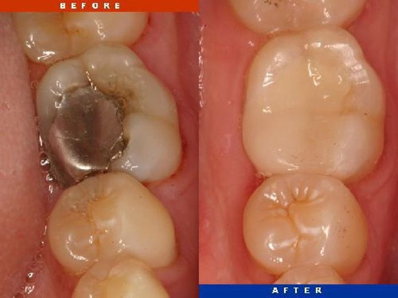 Hình ảnh khách hàng trước và sau hàn trám răng