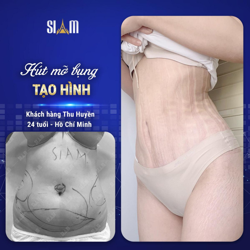 Hút - Cấy mỡ Body Jet - Viện Thẩm mỹ SIAM Thailand