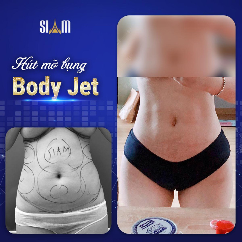 Hút - Cấy mỡ Body Jet - Viện Thẩm mỹ SIAM Thailand