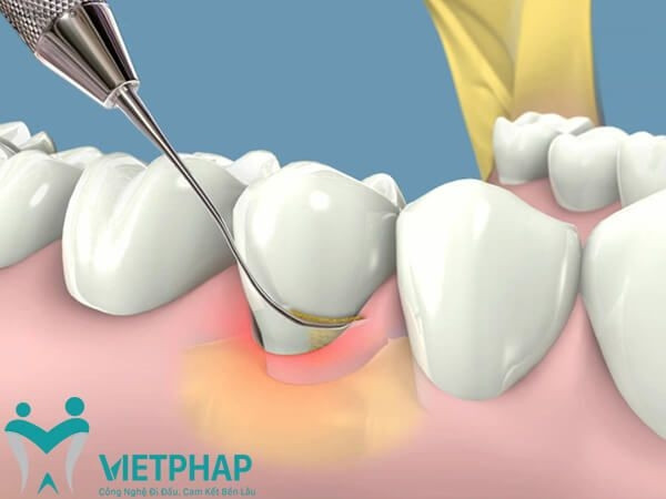 Công nghệ lấy cao răng siêu âm.