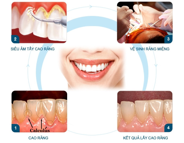 Quy trình lấy cao răng theo tiêu chuẩn Hoa Kỳ.