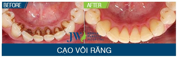 Kết quả thay đỗi rõ nét trước và sau lấy cao răng tại JW Hàn Quốc