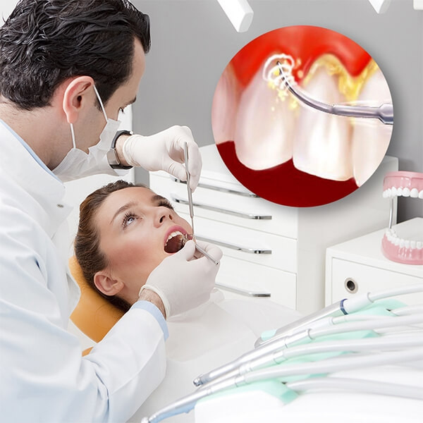 Lấy cao răng tại nha khoa Kim không làm hại răng thật