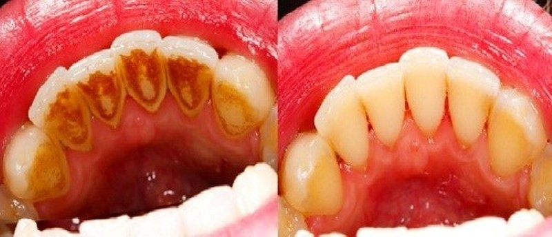 Hàm răng biến đổi rõ rệt trước và sau cạo vôi răng