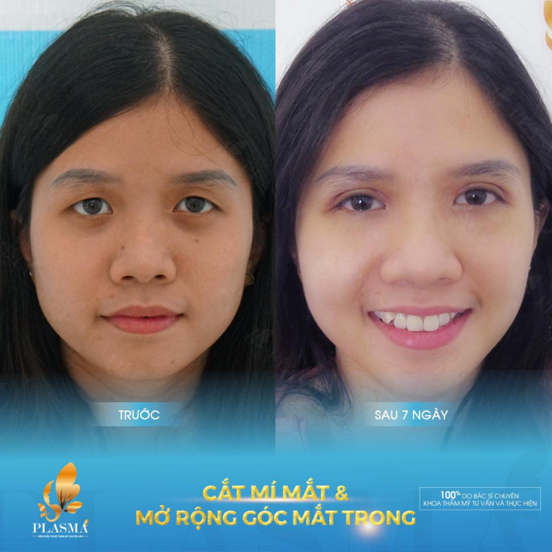 Hình ảnh trước và sau khi cắt mí tại Viện phẫu thuật thẩm mỹ Plasma