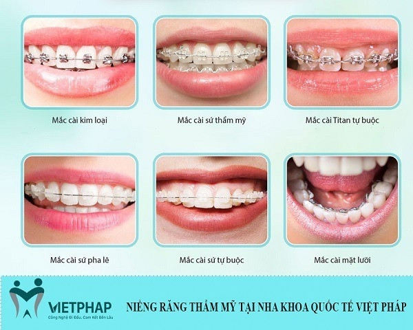 Những loại mắc cài niềng răng thẩm mỹ đang áp dụng tại Việt Pháp