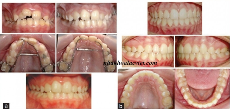 Hình ảnh khách hàng trước và sau niềng răng tại nha khoa Lạc Việt