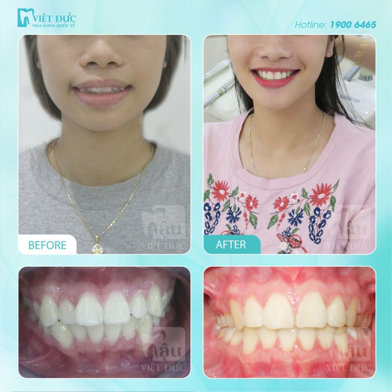 Hình ảnh khách hàng trước và sau niềng răng tại Việt Đức