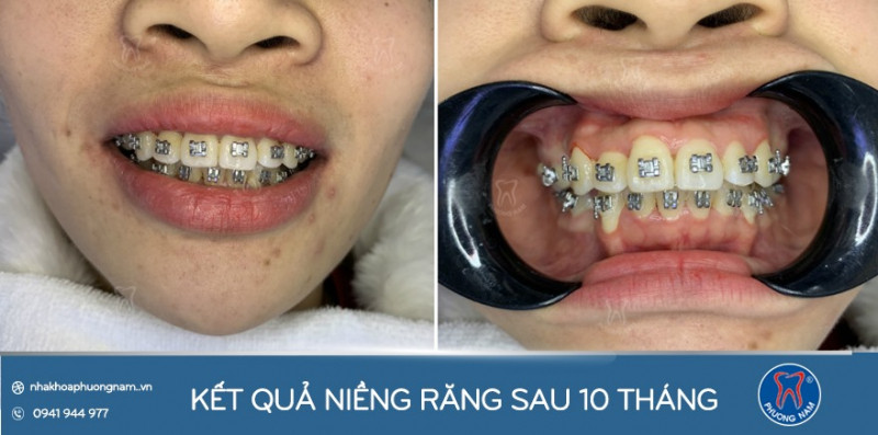 Kết quả niềng răng sau 10 tháng tại Nha khoa Phương Nam