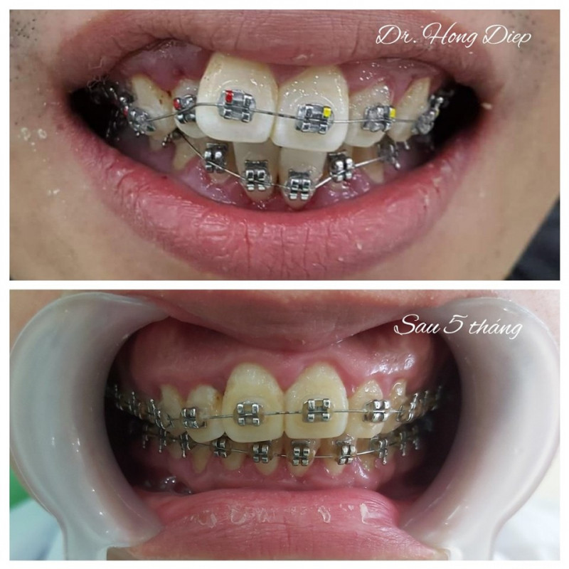 Kết quả sau 5 tháng niềng răng tại Nha khoa Hồng Điệp