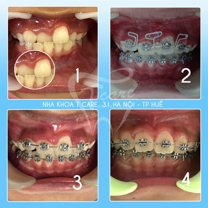 Hàm răng thay đổi từng ngày khi sử dụng dịch vụ niềng răng tại Nha khoa Tcare
