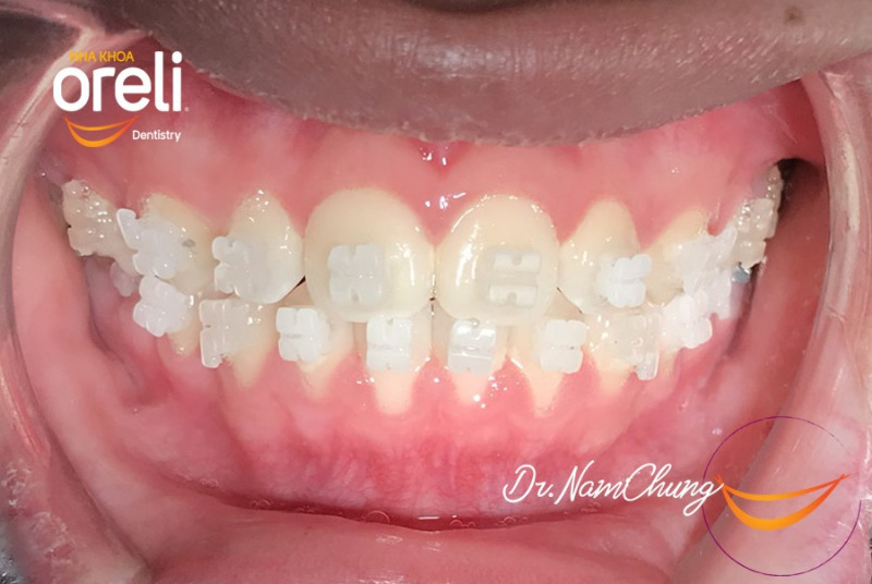 Sau 5 tháng niềng răng tại Nha Khoa Oreli hàm răng cắn ngược của khách đã được nắn chỉnh về đúng vị trí
