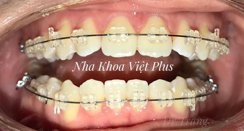 Hình ảnh niềng răng tại Nha khoa Việt Plus