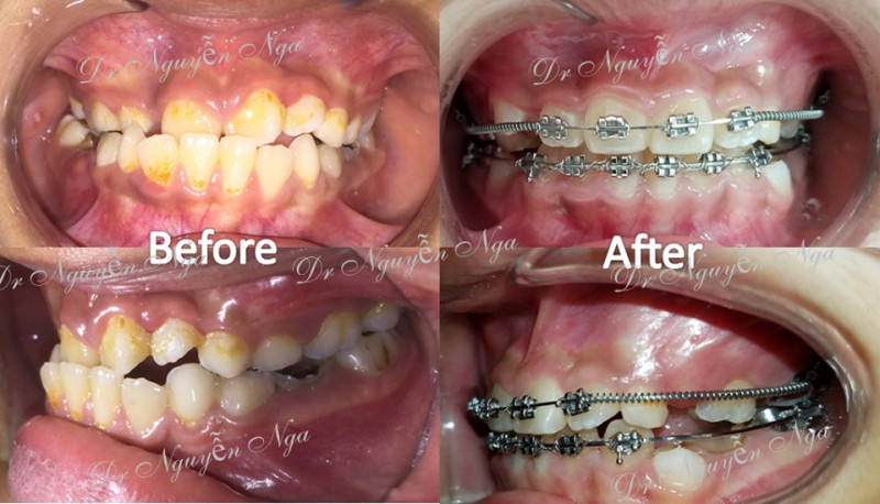 Hình ảnh trước và sau khi niềng răng tại Nha khoa Nụ cười