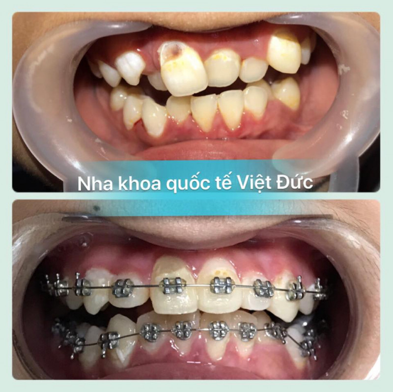 Hình ảnh trước và sau khi niềng răng tại Nha khoa Quốc tế Việt Đức