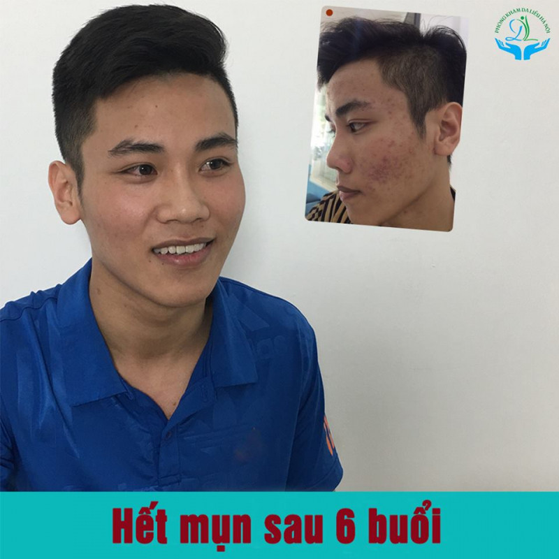 Phòng Khám Da Liễu Trị Mụn Hà Nội