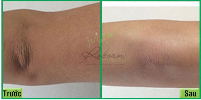Trước và sau khi trị thâm khuỷu tay hiệu quả tại Reborn Clinic.