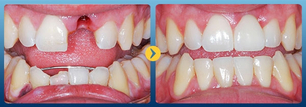 Hình ảnh khách hàng trước và sau điều trị trồng răng Implant tại nha khoa Kim