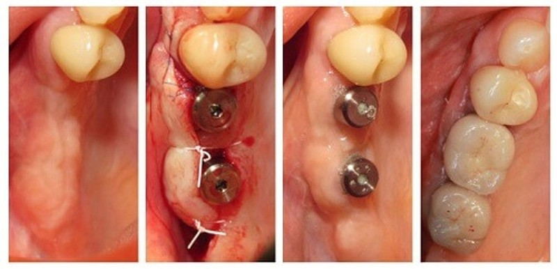 Kết quả sau trồng răng tại Răng hàm mặt Trung ương