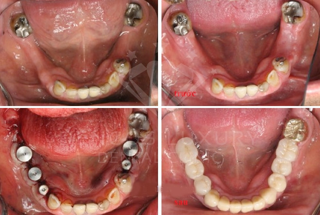 Kỹ thuật trồng răng Implant tại Nha Khoa Quốc Tế Dencos Luxury﻿