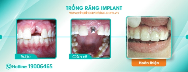 Khách hàng trồng răng implant tại nha khoa Việt Đức