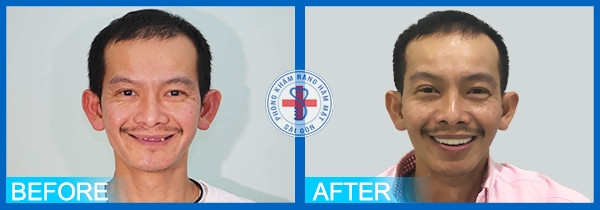 Khách hàng trước và sau trồng răng implant tại Răng hàm mặt Sài Gòn