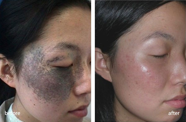 Vết bớt đen trên mặt gần như biến mất hoàn toàn với công nghệ hiện đại tại TMV Jenna Thanh