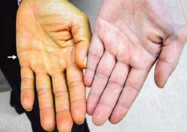 Đa số bệnh nhân mắc bệnh gan sẽ có triệu chứng vàng da