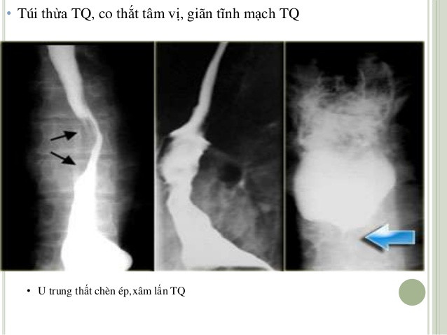 Chụp X-quang thực quản