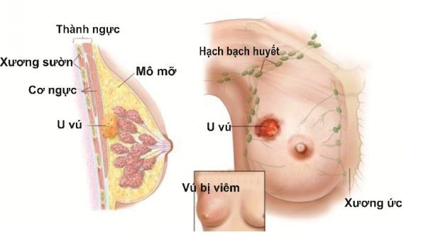 Nổi u cục ở tuyến vú