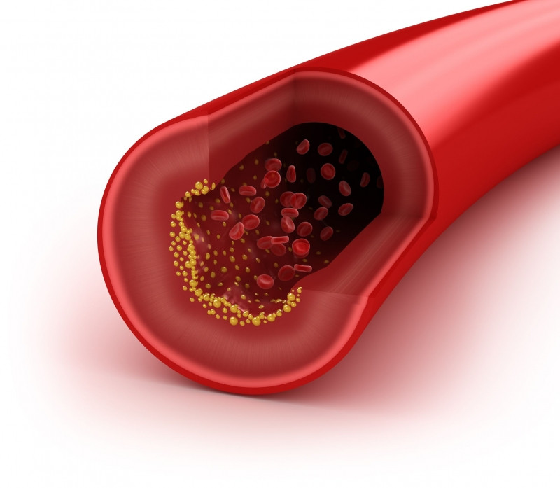 Cholesterol trong máu quá cao gây hại cho sức khỏe