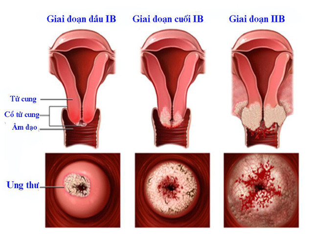 Ung thư cổ tử cung