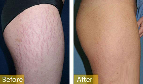 Hiệu quả của kem trị rạn da trước và sau sinh Stretch Line