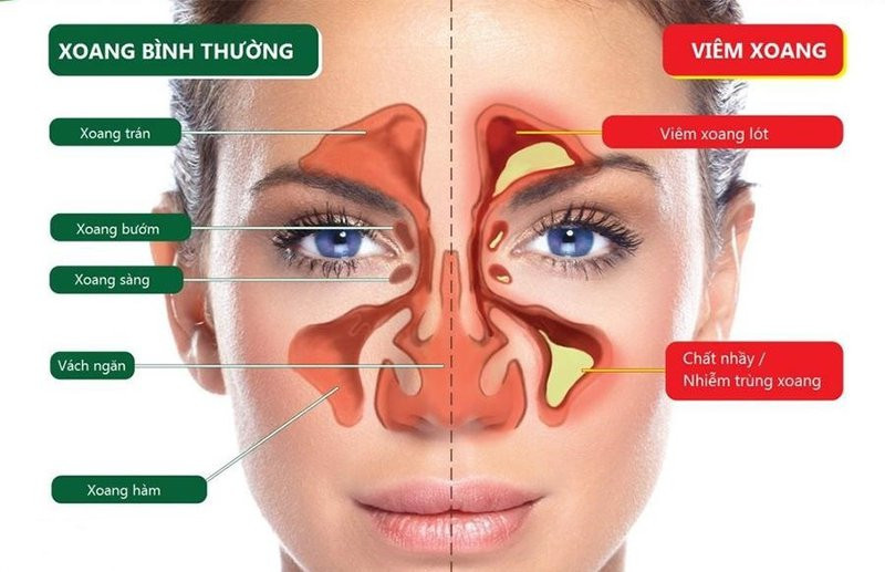 Cây kinh giới chữa viêm xoang hiệu quả