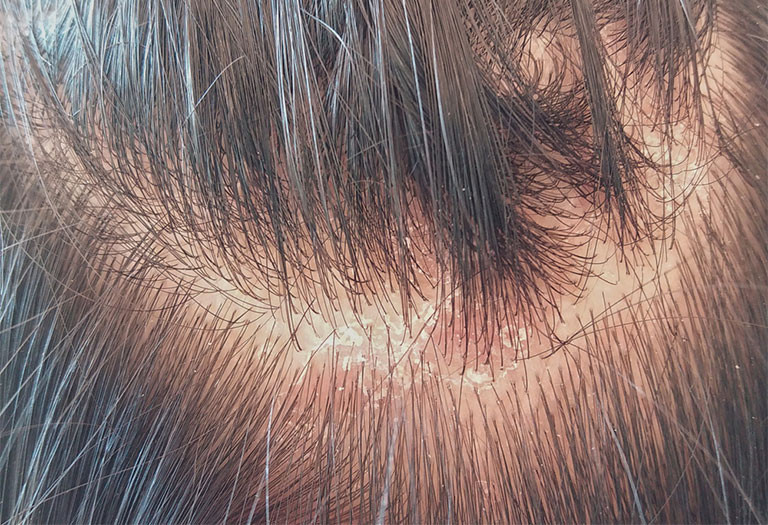 Bệnh lý nấm da đầu gây rụng tóc nhiều