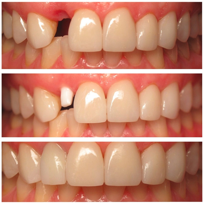 Trước và sau khi làm răng