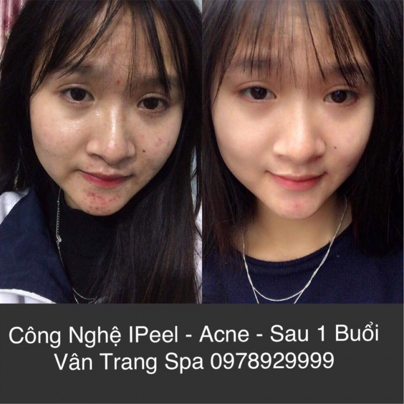 Khách hàng sau 1 buổi điều trị mụn tại Vân Trang Spa