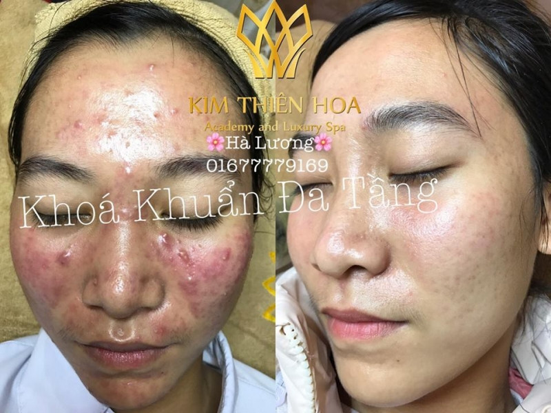 Kim Thiên Hoa Spa là địa chỉ chuyên chữa những ca mụn nặng.