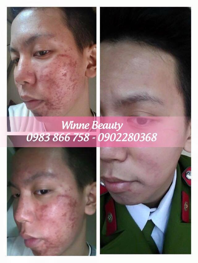 Có rất nhiều khách hàng đã trị dứt điểm mụn khi đến với Giang Winnie Beauty & Spa