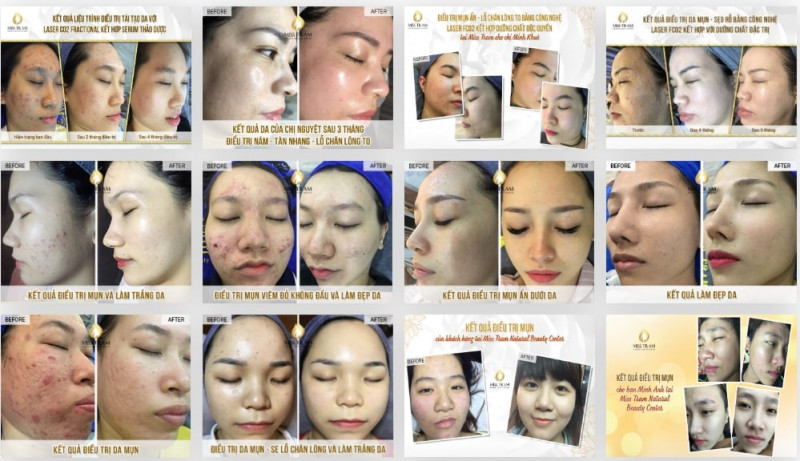 Miss Trâm Spa: Nơi chuyên điều trị nám, tàn nhang uy tín hơn 15 năm ở HCM