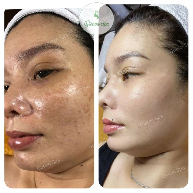 Thẩm Mỹ Queen Spa