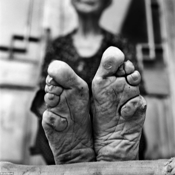 Tục bó chân ở Trung Quốc.