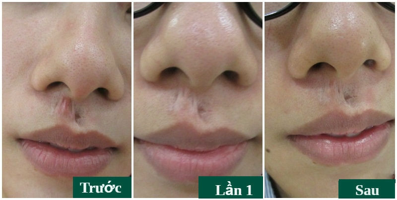Hình ảnh khách hàng trước và sau khi điều trị sẹo lồi tại Đông Á